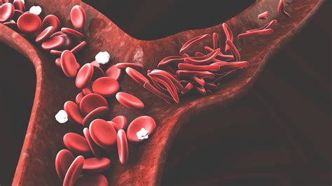sintomas de anemia falciforme - revolvedora de cemento